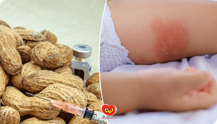 حساسیت به کره بادام زمینی