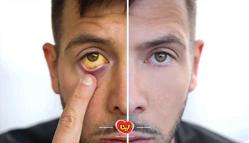 علائم سندروم ژیلبرت